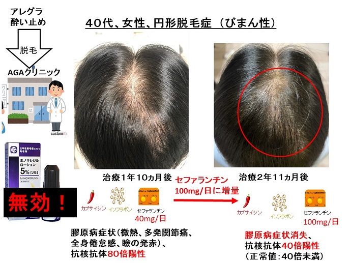 円形脱毛症　病院